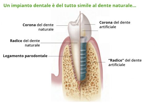 Dente impianto