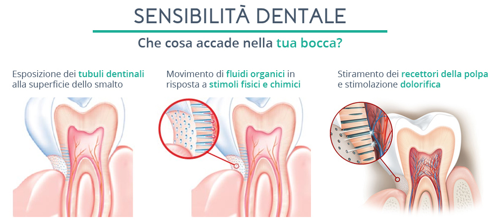sensibilita dentale