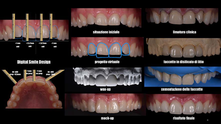 Digital smile design 1