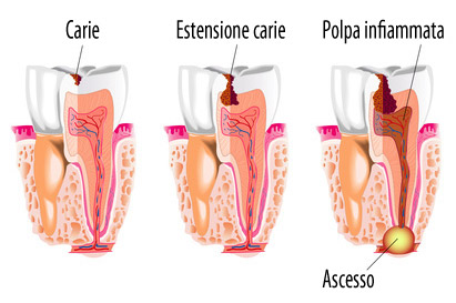 ascesso dentale