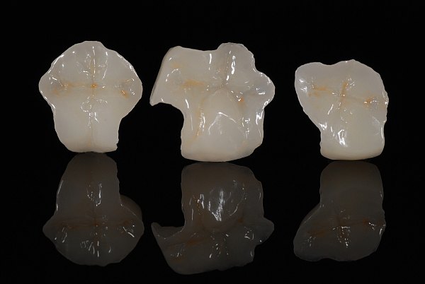 intarsi dentali
