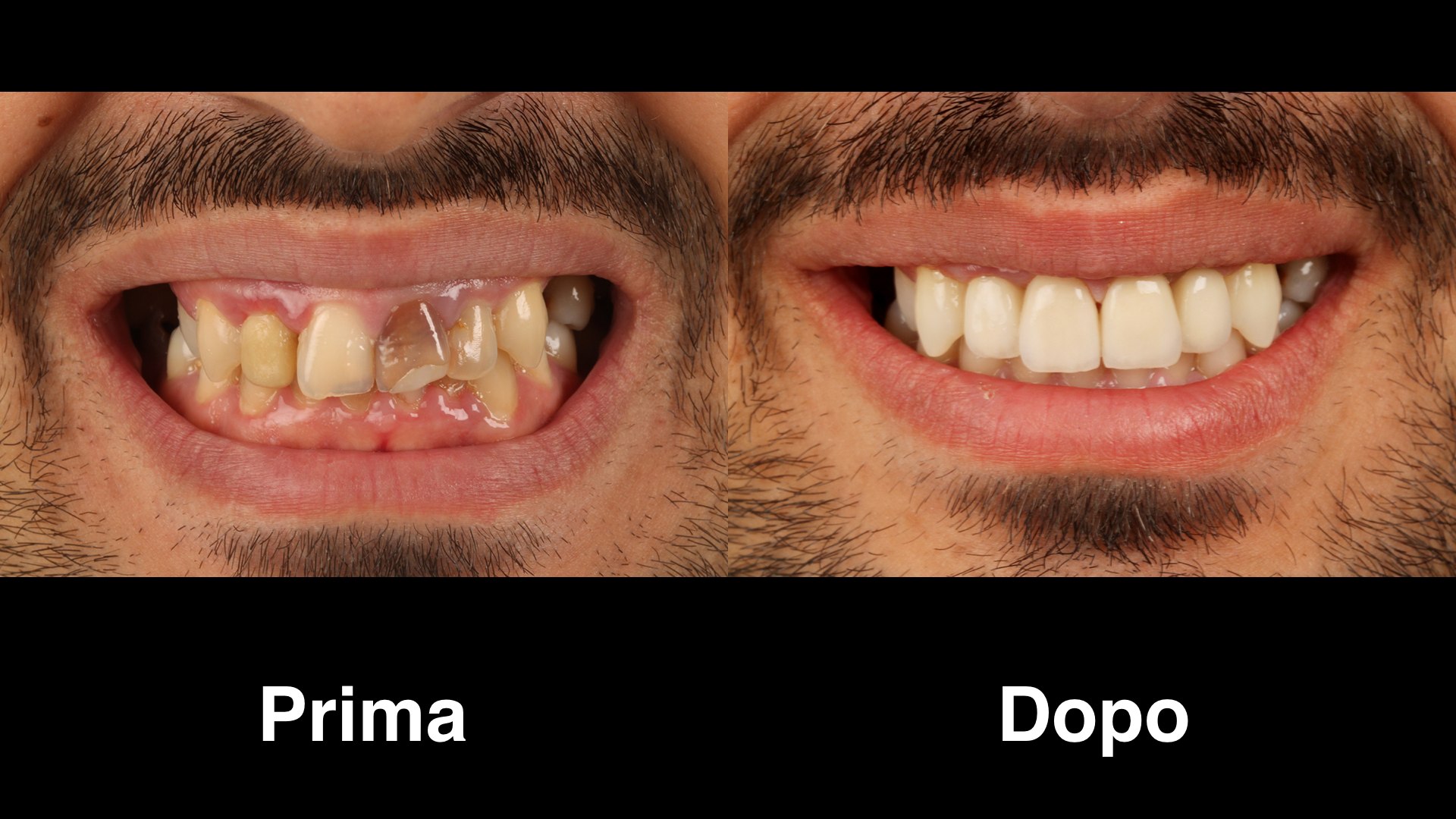 prima dopo faccette dentali