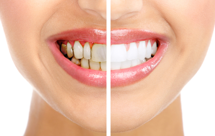spazzolamento dentale scorretto