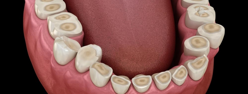 erosione dentale 