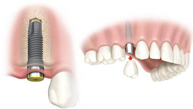 impianto dentale 1